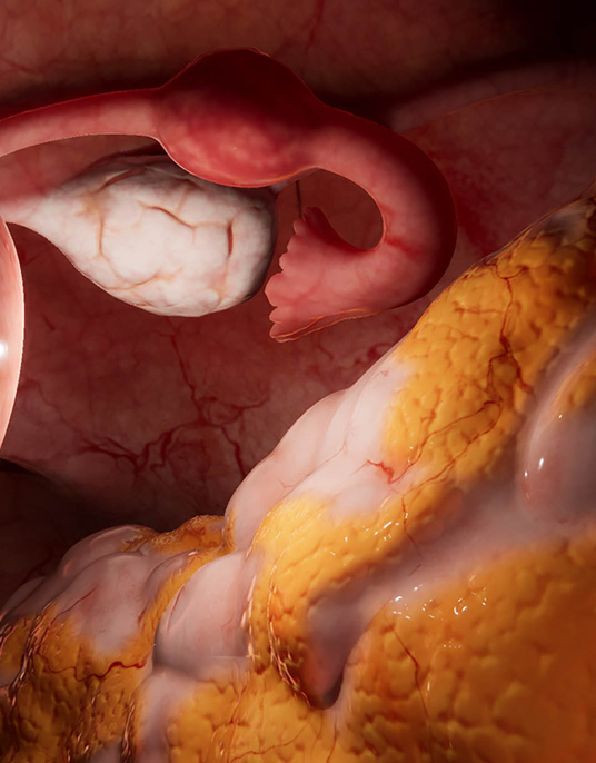 Laparoscopic Salpingectomy