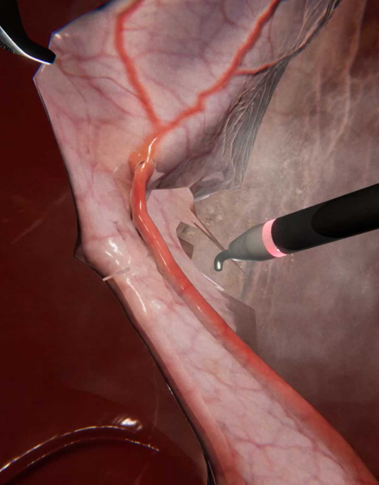 The laparoscopic cholecystectomy