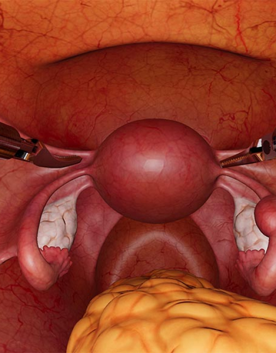 Salpingectomy procedure 🧑⚕️